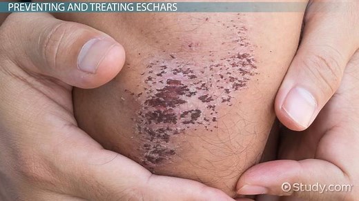 Eschar | Definition, Treatment & Prevention