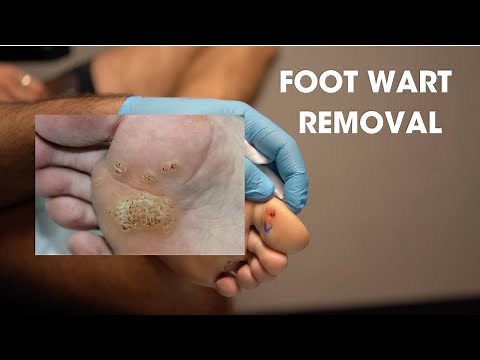 Foot Wart Removal