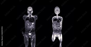 MRI whole body scan Coronal T2 and T1 by MRI scanner.