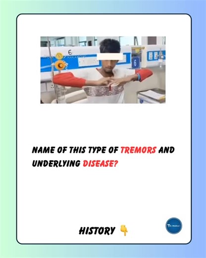H.N.Ali (Dx & Tx)✨ on Instagram: "✨ Dr Medica || Clinical Cases A patient is shown holding the arms abducted with elbows flexed, producing a coarse, flapping-like tremor. ❓ Ask: • What is the name of this tremor? • What is the underlying disease? #ClinicalCases #Neurology #MovementDisorders"