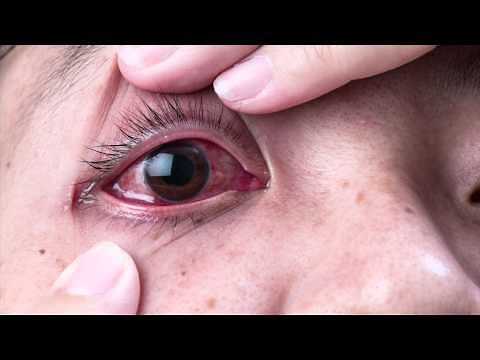 Ask The Expert - Dr. Gabriel Sosne - Pink Eye and Viral Eye Infections