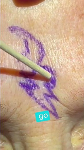 SCAR REVISION WITH GBLC (GEOMETRIC BROKEN LINE CLOSURE) - DR. TANVEER JANJUA - NEW JERSEY