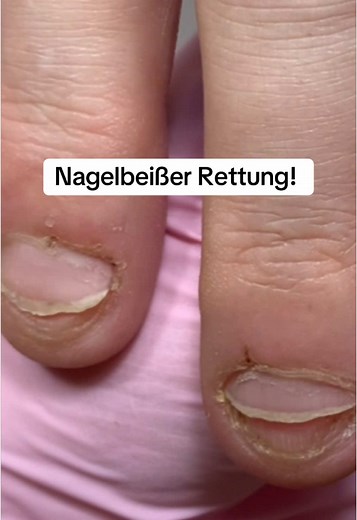 Nagelbeißer Rettung: Tipps für schöne Nägel zu Hause