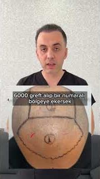 SAÇ EKİMİNDE PLANLAMA