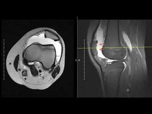 Patellar dislocation with large displaced patellar fragment