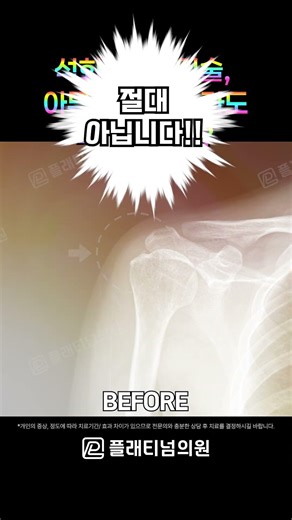 [플래티넘의원] 석회화건염 치료 고민이라면 석회분쇄흡입술 꼭 보세요