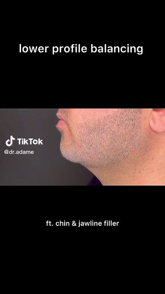 Enhance Your Appearance with Dermal Fillers for Chin and Jawline Contouring