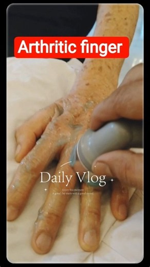 Arthritic Finger Relief Vlog | Finger Arthritis Exercises & Therapy | Health Valley