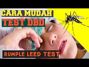 CARA MUDAH DETEKSI DBD DENGAN RUMPLE LEED TEST