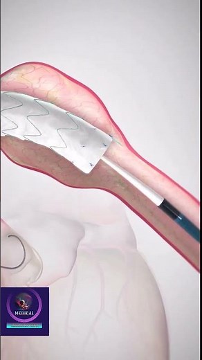 Aortic Stent Grafts -Thoracic Endovascular Aortic Repair #shorts