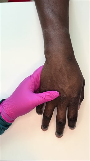 Hand Drawing With A 21g Butterfly 🦋 As A Forensic Phlebotomist I Want To Have Control Of My Needle Especially When Working With Combative’s, This Technique Gives Me Full Control And Allows For Fast Procedure Time 👀