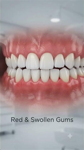 What Is Gingivitis? A USA Dentist Explains Why Gums Bleed and How to Stop It
