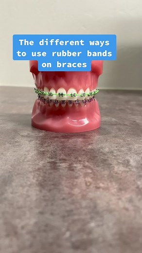 Exploring Different Ways to Use Rubber Bands on Braces