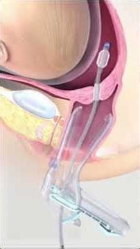 If you’re getting prepared for an induction of labor you may have heard of a foley induction or