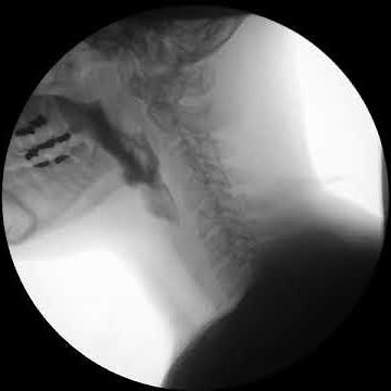 Modified Barium Swallow MBS or VFSS