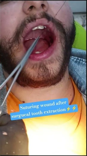 Closing surgical wounds with precision stitches #dentist #stitch #medical
