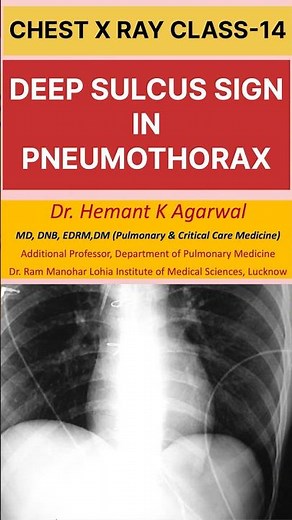 CXR-14: DEEP SULCUS SIGN in Chest X Ray seen in Pneumothorax ‪@dr.hemantkumaragarwal-pccm7789‬