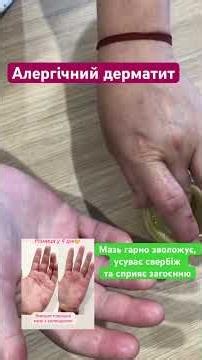 Сухість рук, дерматит, псоріаз