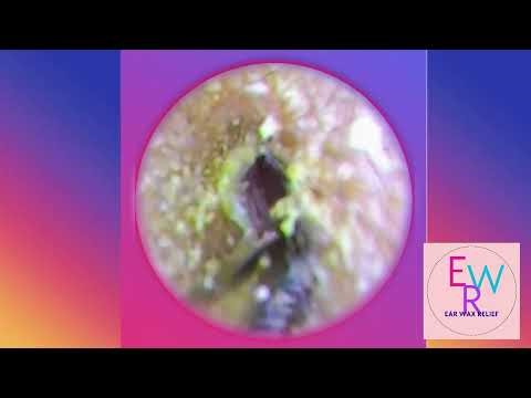 ASMR 👌👌EARWAX RELİEF
