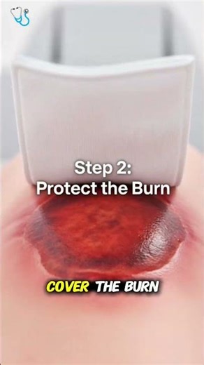 First Aid for Burns: What You Should Do Immediately