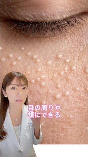 目の周りの白い粒、稗粒腫（はいりゅうしゅ）かも。皮膚科でできる処置を解説。