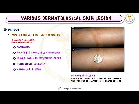 How to Identify Various Dermatological Skin Lesions : Dermatology Basics
