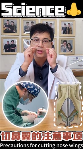 Dr.Nico Chan on Instagram‎: "Dr. Chen‘s mini-class is now open! Today’s topic is about the adjustment of the nasal alar 👃. If you‘re interested, you can add me to schedule an online consultation 👇 http://api.whatsapp.com/send/?phone=886919141153&text=Hi,Dr.Chen #rhinoplasty #鼻整形 #隆鼻 #鼻子 #nose #鼻整形ダウンタイム #การผ่าตัดเสริมจมูก #隆鼻術 #鼻修复 #تجميل #鼻综合 #新加坡 #3d #nosejob #nosejobs #nosesurgery #rhinoplastie #rhinoplastic #singapore #singapur #singapura"‎