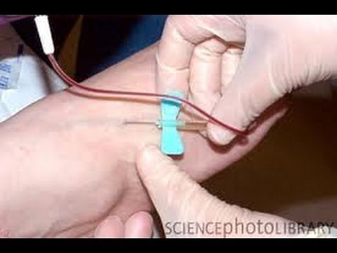 Butterfly Venous cathether placement