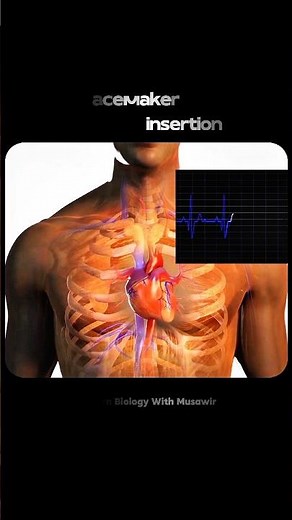 Pacemaker Insertion in 3D | Medical Animation Short