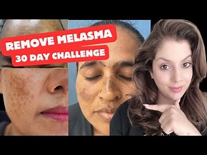 How to remove Melasma at home | 30 day challenge | Nipun Kapur