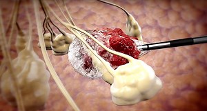 Cryoablation for tumor destruction: what is cryoablation therapy?