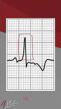 Mastering ECG Interpretation: Right Ventricular Hypertrophy Explained for Medical Students