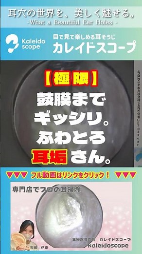【極限】鼓膜までギッシリ。ふわとろ耳垢さん。