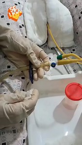 Como coletar a urina do paciente em uso de sonda fôlego. Confira esse passo a passo. #enfermagem #sondafoley #sondavesical #coletadeurina Video: @jmn_cursos_treinamentos | Enfermagemesf