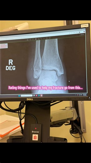 Essential Products for Ankle Fracture Recovery