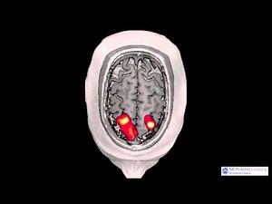 Cerebral resting state networks - fMRI