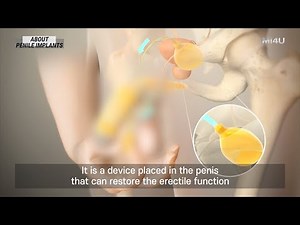 [Penile Implants] What are They?_Inflatable Penile Prosthesis_ED Surgery_ED definitive treatment