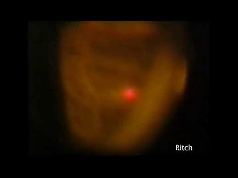 Argon Laser Peripheral Iridoplasty (ALPI) The BEST VIDEO! Robert Ritch, MD