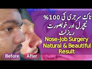 Transformative Rhinoplasty Before and After | Nose-Job Surgery by Dr. Habib