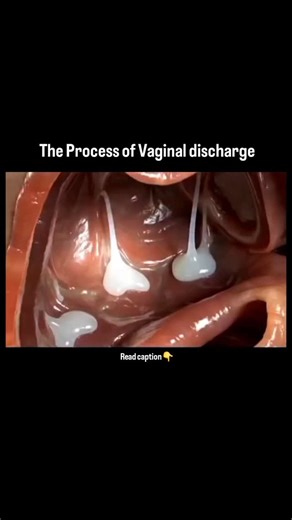 World of Biology on Instagram: "“Vaginal discharge is a natural process where the cervix produces mucus to clean and protect the vagina, changing in consistency throughout the menstrual cycle. “💡 Its texture, color, and amount vary depending on hormonal fluctuations, especially estrogen levels. Around ovulation, it often becomes clear, stretchy, and slippery—similar to egg whites—to help sperm travel more easily. Before or after periods, it may appear thicker, creamier, or slightly cloudy. This
