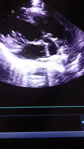 Rare Congenital Heart Defect Case: AVCD with TGA | Syed Gulzar Shah DOH (HAAD)/ DHA eligibility posted on the topic | LinkedIn