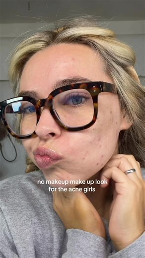 No makeup makeup for the acne girlies! #acne #makeuptutorial | Kylie Tuttle