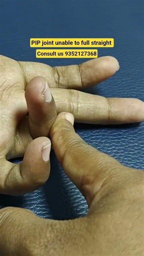 finger deformity #physiotherapy #stiffness #splint #plaster #k-wire #finger#thumb #movement #ruhs