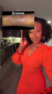 ✨Where to buy: Linked up. You can ask ChatGPT or DeepSeek as well. ▪️Eczema: Tacrolimus or 1% Hydrocortisone Cream Colloidal Oats Cream/Baths ▪️Genital warts: Imiquimod Cream or Cryotherapy or ACV soaks (can 🔥) ▪️Heat rash: Hydrocortisone 2.5% or Calamine Lotion ▪️Spider veins: Compression socks Diosmin/Horse Chestnut Supplement or Sclerotheraphy ▪️Psoriasis: MG217 Coal Tar Shampoo UVB Lamp or Skyrizi (risankizumab) ▪️Vitiligo: Opzelura or Topical Vit.D Sun Exposure Happy Mother’s Day to all th