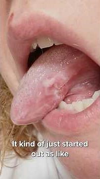 My First Symptoms of TONGUE CANCER!