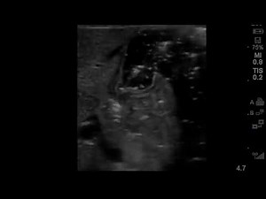 Projectile Vomiting in 2 week old Baby Girl: PoCUS of Normal Pylorus