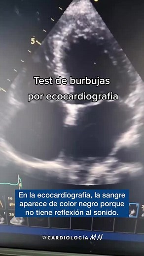 Test de burbujas por ecocardiografía #ecocardio #cardiologia #cardiologia #medicina #aprendeentiktok