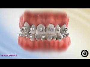 Posterior Crossbite Correction Using Sequential Archwires | Dental Braces | Temecula Valley, CA