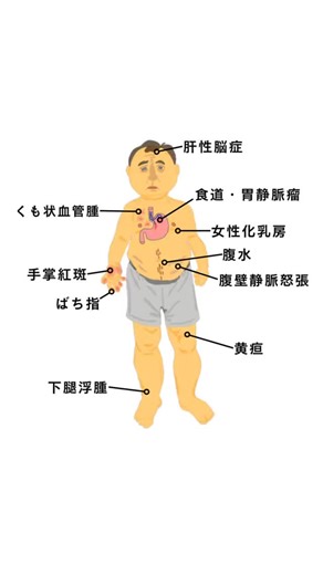 ハックルベリージャム/ illustration | 一目でわかる「肝硬変の症状」 アニメーションで詳しく解説しました。 ⚠︎動画後半は吐血シーン（食道静脈瘤破裂）を含むため、注意してご覧ください。 1. 脳への影響（肝性脳症） 2. 血管の変化（クモ状血管腫・手掌紅斑） 3. 水の溜まり（腹水・浮腫） 4. 命の危険（静脈瘤破裂） | Instagram