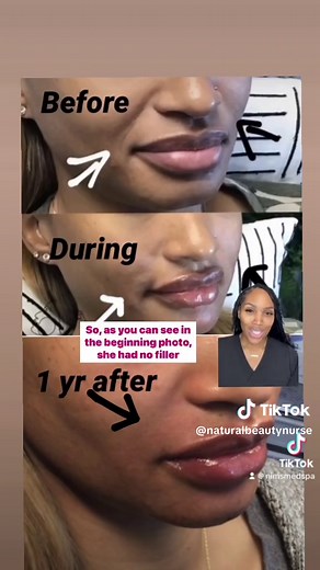 Transform Your Smile Lines with Nasolabial Fold Filler